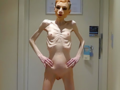 Anorexia Christin showing her Bones & Skinny Skeleton